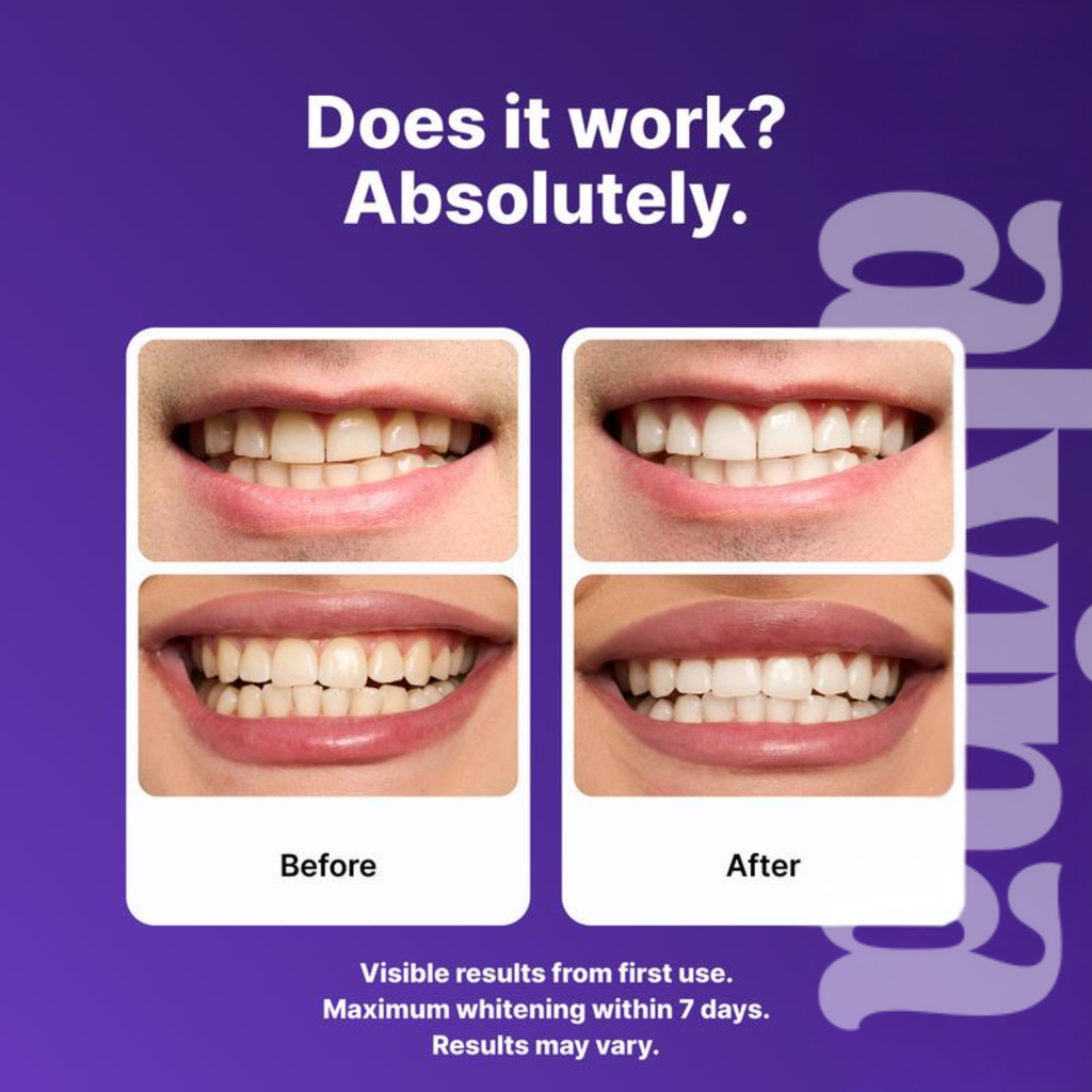 Alvina - Whitening Strips